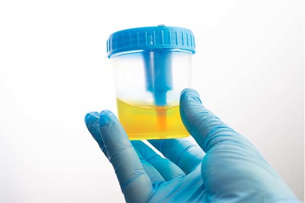 Esame citologico delle urine: come farlo, quando farlo, come leggere i risultati