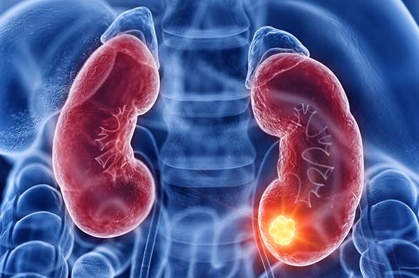 Tumore al rene: i sintomi