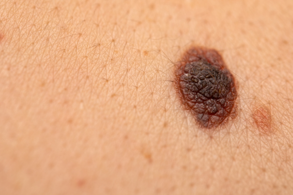 Cosa fare se si stacca un neo