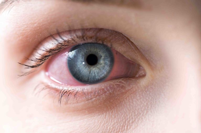 Congiuntivite solare