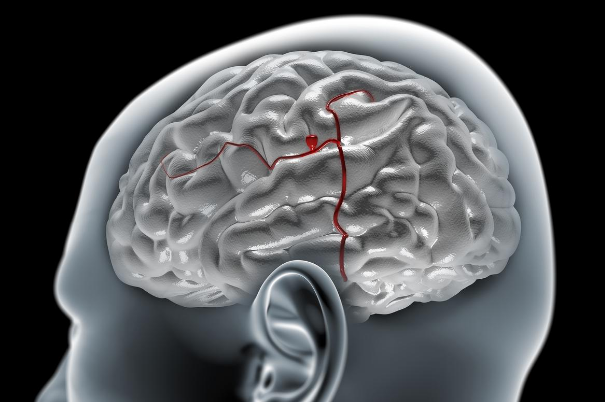 Aneurisma celebrale: i rischi per le donne fumatrici