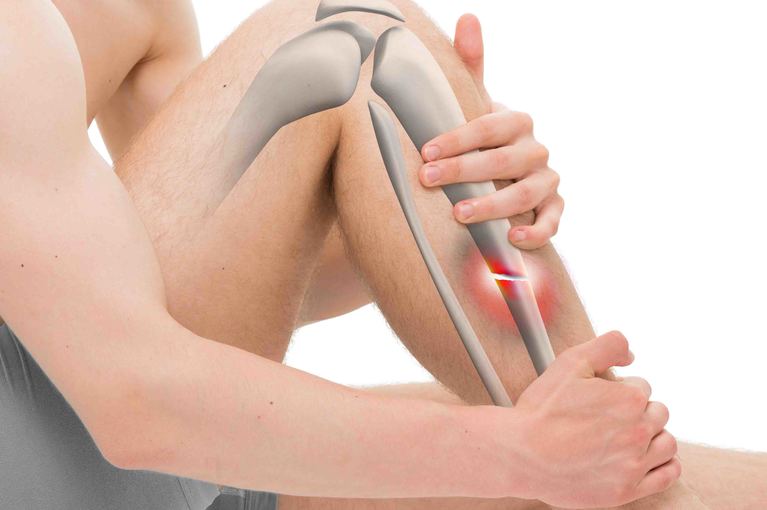 Frattura ossea nei giovani