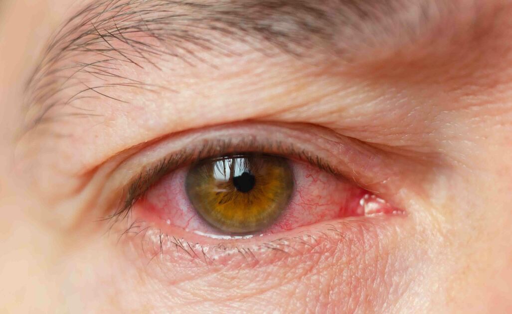 Congiuntivite da contatto 