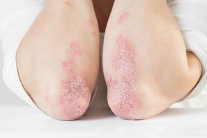 Psoriasi: in arrivo una nuova cura?