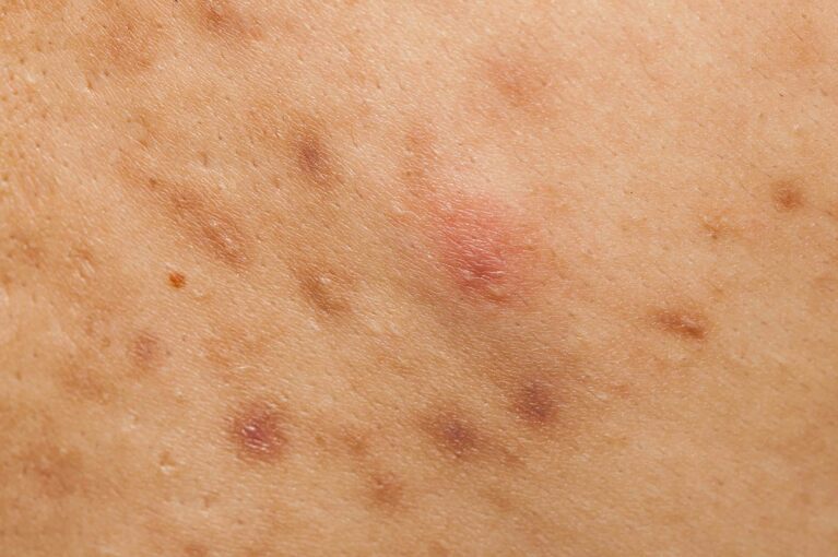 Cicatrici da acne