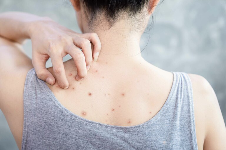 Acne Acne del Tronco