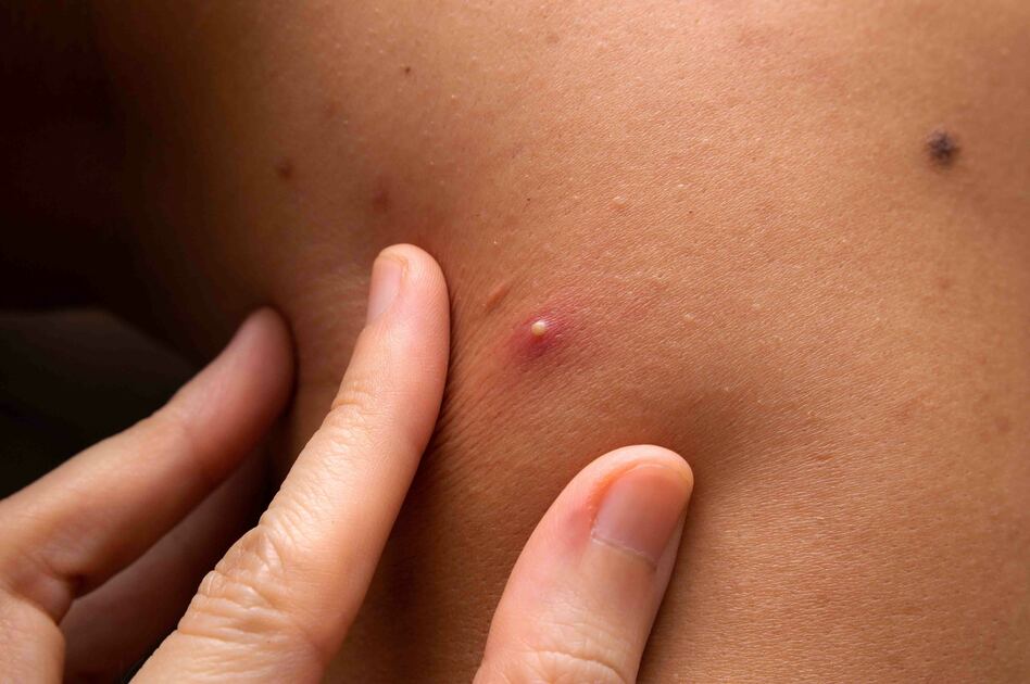 Schiacciare un Brufolo