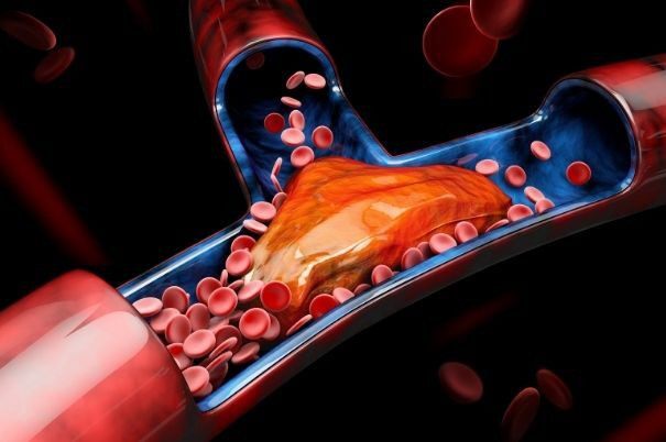 Trombo all'Interno di una Vena