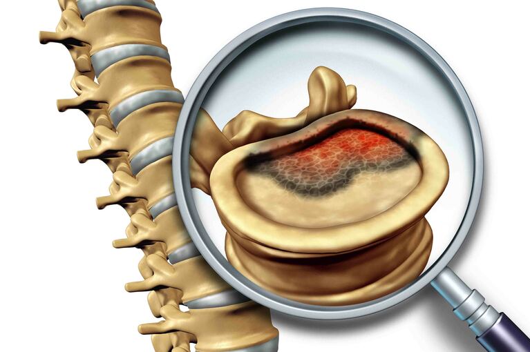 Tumore alle vertebre