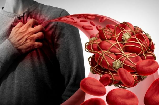 Coagulo di Sangue nel Cuore di un Paziente che si Tocca il Petto