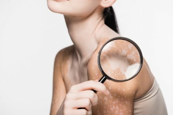 Donna con Vitiligine avvicina una Lente di Ingrandimento alla Spalla