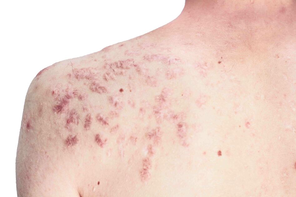 Retinoidi: Cosa Sono