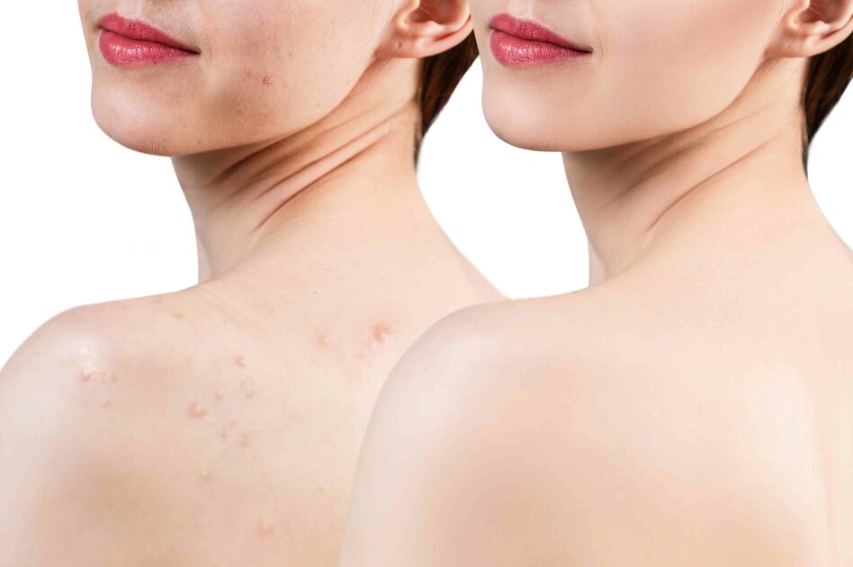 Acne e Cure Antibiotiche