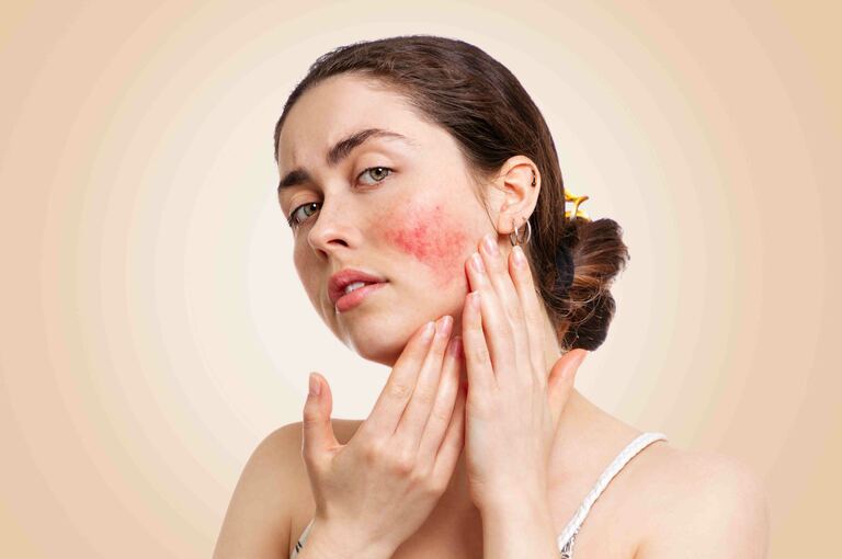 Rosacea: come trattarla