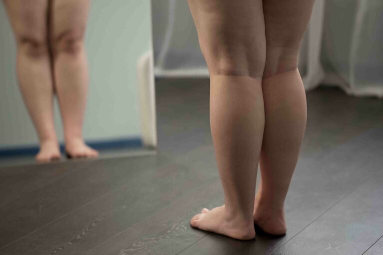 Lipedema: cosa è