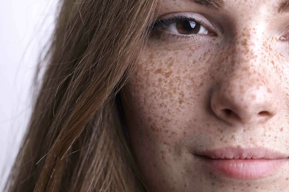 Efelidi: Cosa sono e Le Cause