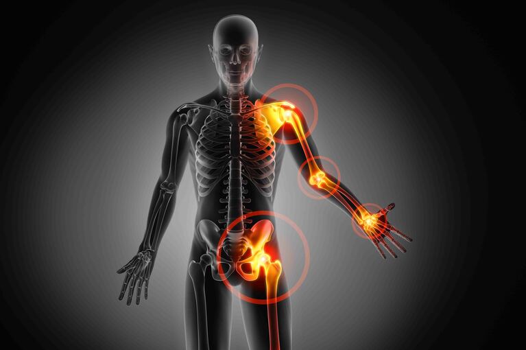 Artralgia e malattia di Chron