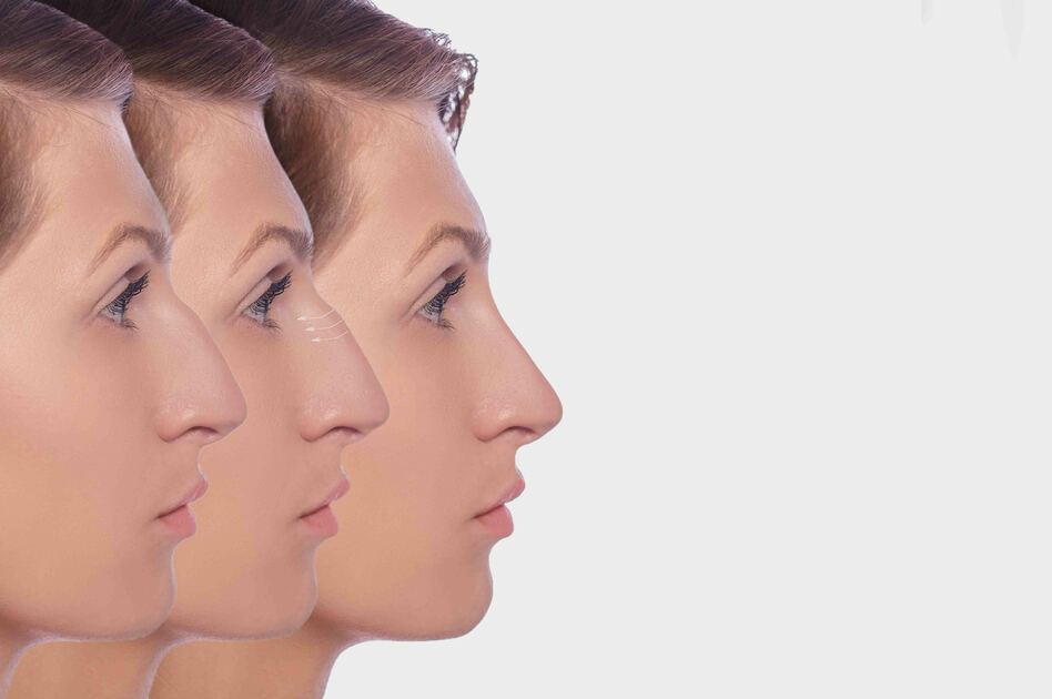 Rinoplastica: I Rischi