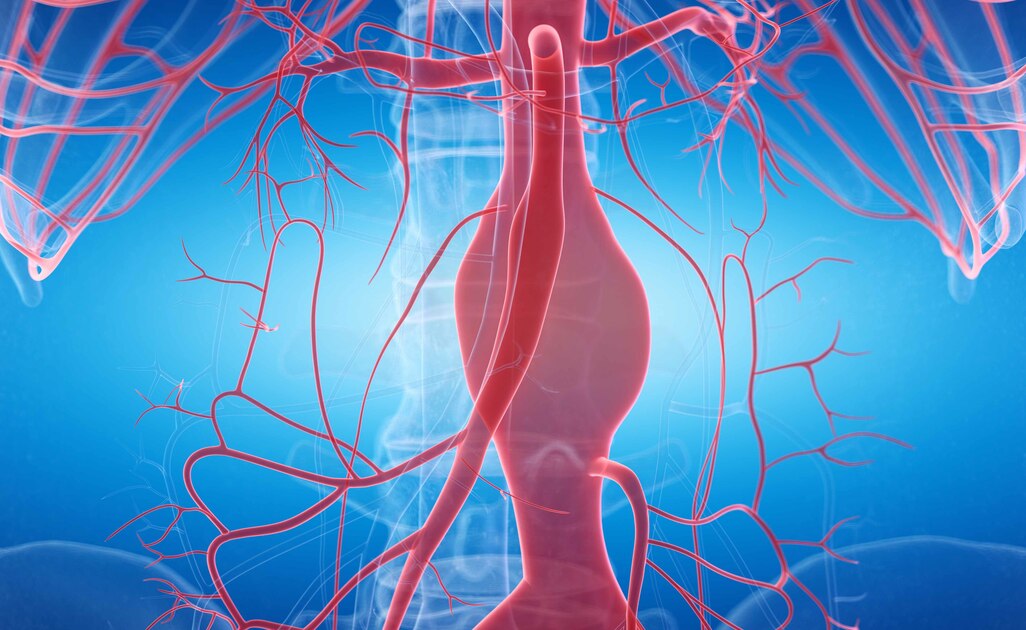 Aneurisma Aortico Addominale