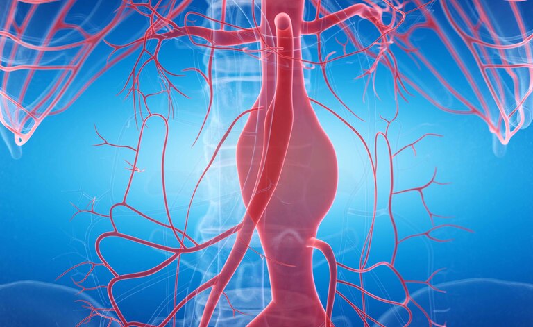 Aneurisma Aortico Addominale