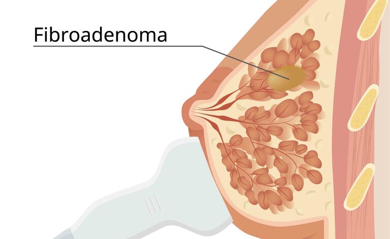 Fibroadenoma: cosa è