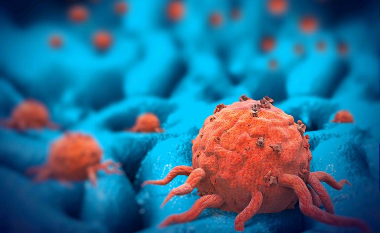 Tumore al seno e Recidive