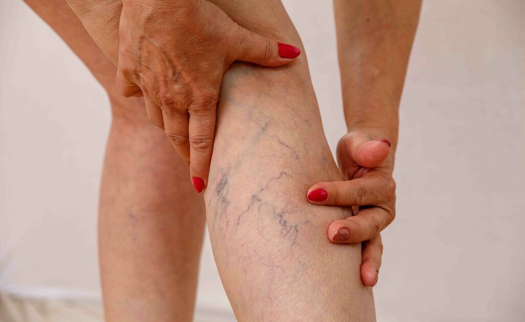 Insufficienza venosa e Freddo