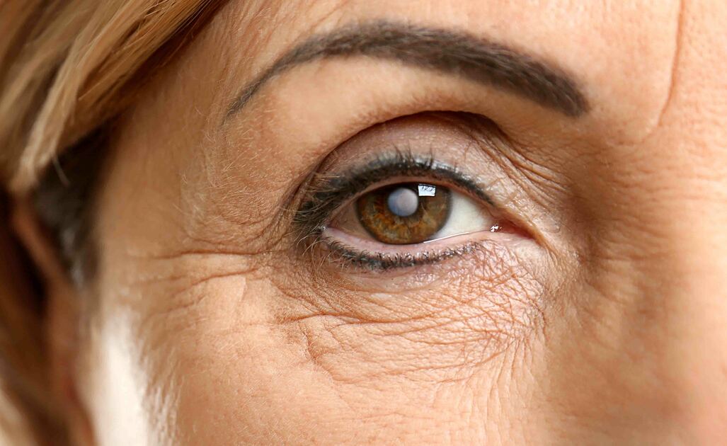 Cataratta e Ictus: il Legame