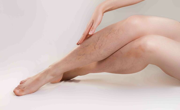 Macchie rosse sulle gambe: le cause