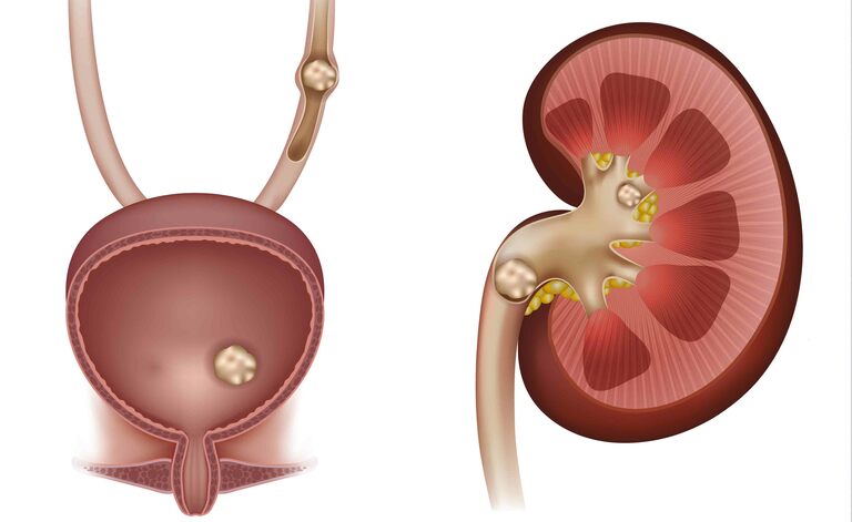 Calcoli renali: cure
