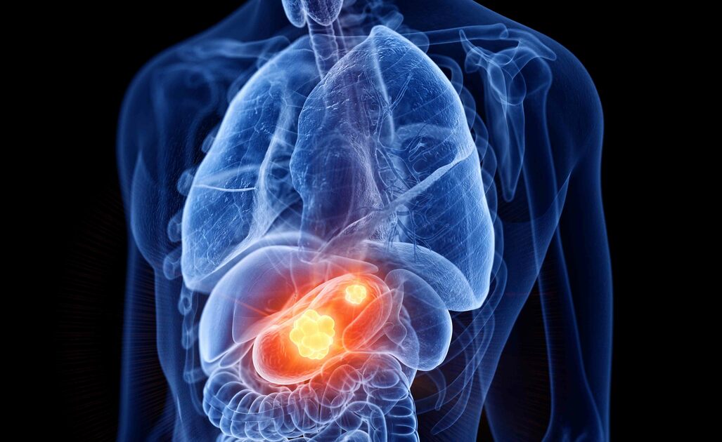 Tumore allo stomaco: fattori di rischio