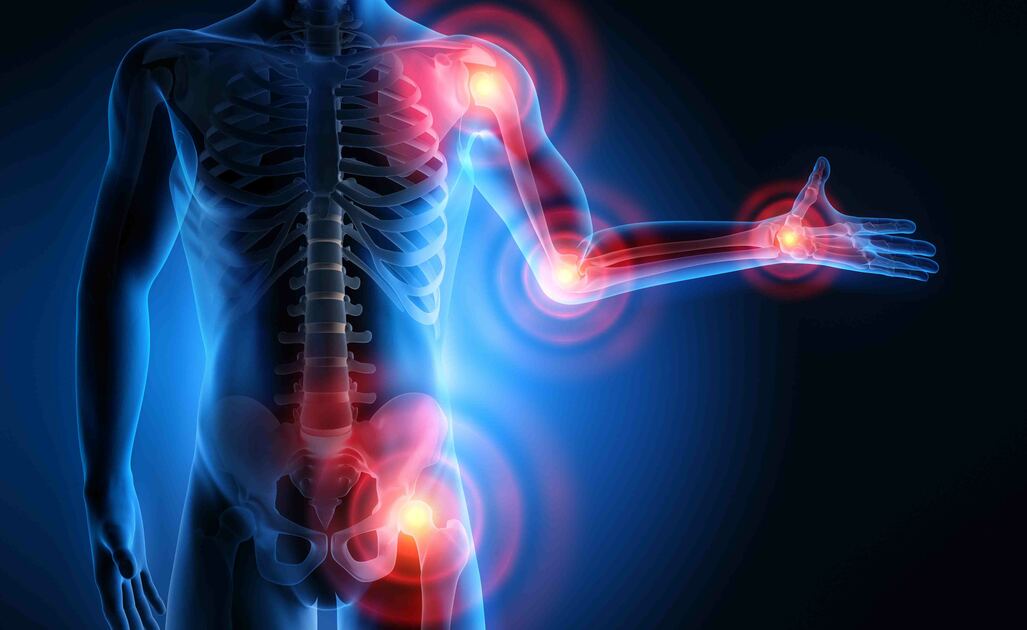 Artrite Reumatoide: Cosa è