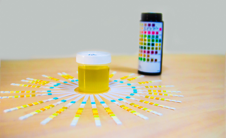 Proteinuria, Cosa é