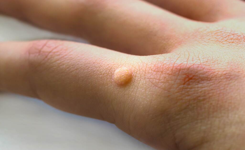 Porro della pelle, come riconoscerlo