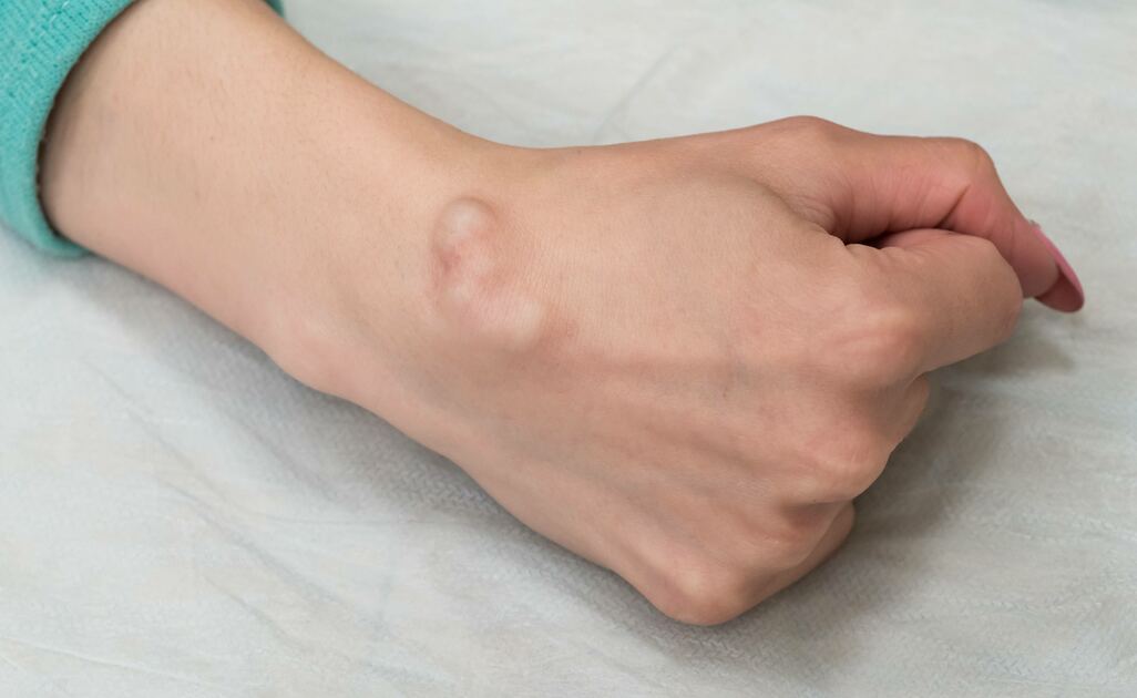 Cisti Al Polso E Alle Mani, Come Trattarle