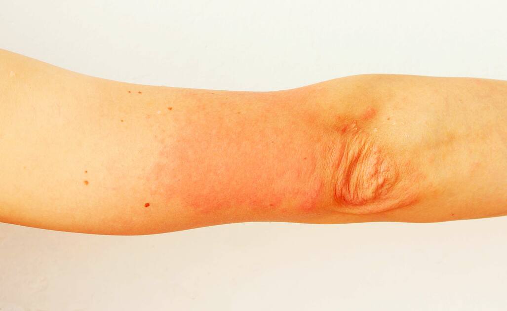 Orticaria Solare: i Rimedi