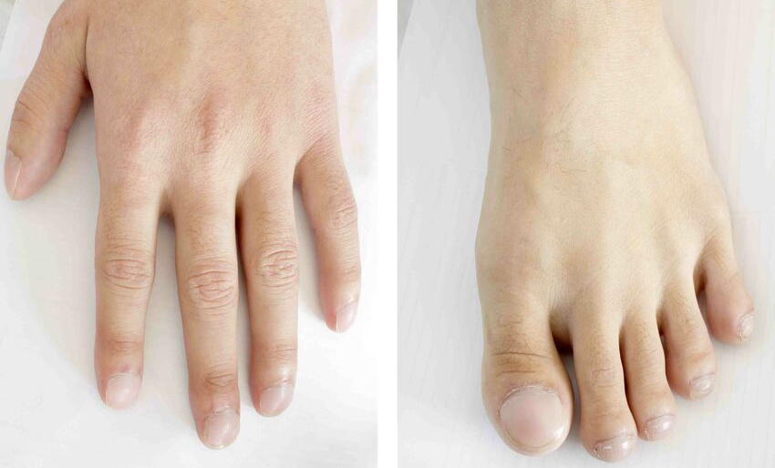 Esiste Una Correlazione Tra Dita A Bacchetta Di Tamburo E Infarto? Pazienti.it Esiste Una Correlazione Tra Dita A Bacchetta Di Tamburo E Infarto? Pazienti.it