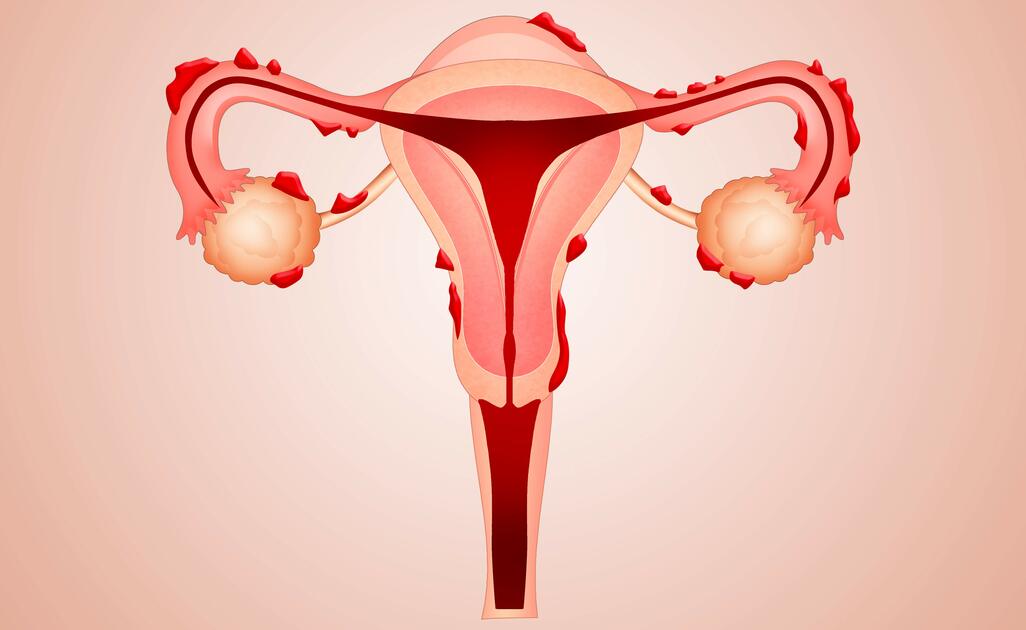 Endometriosi e Cisti Endometriosiche