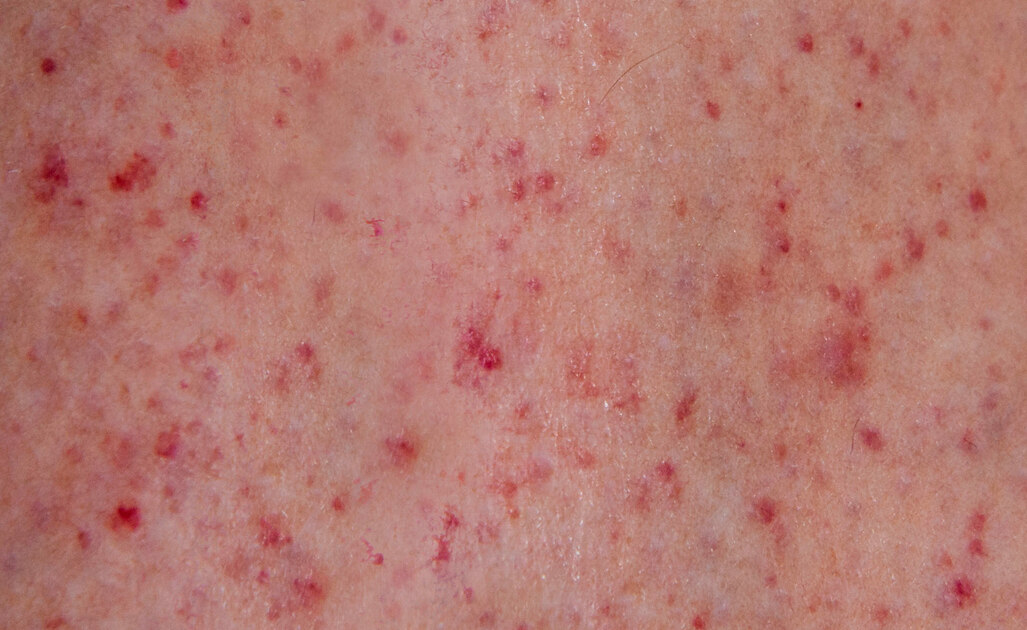 Petecchie: le Cause della formazione