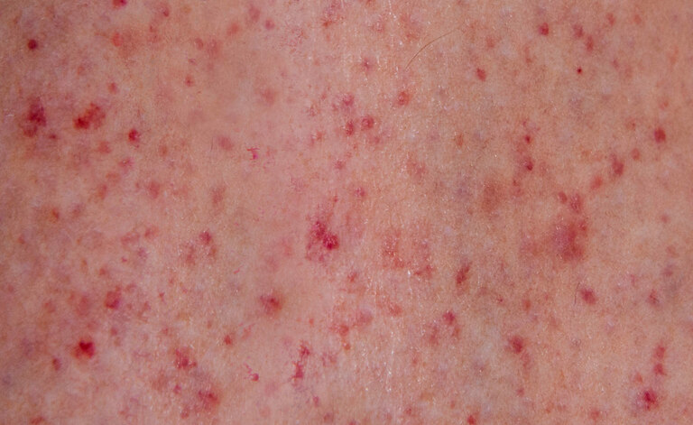 Petecchie: le Cause della formazione