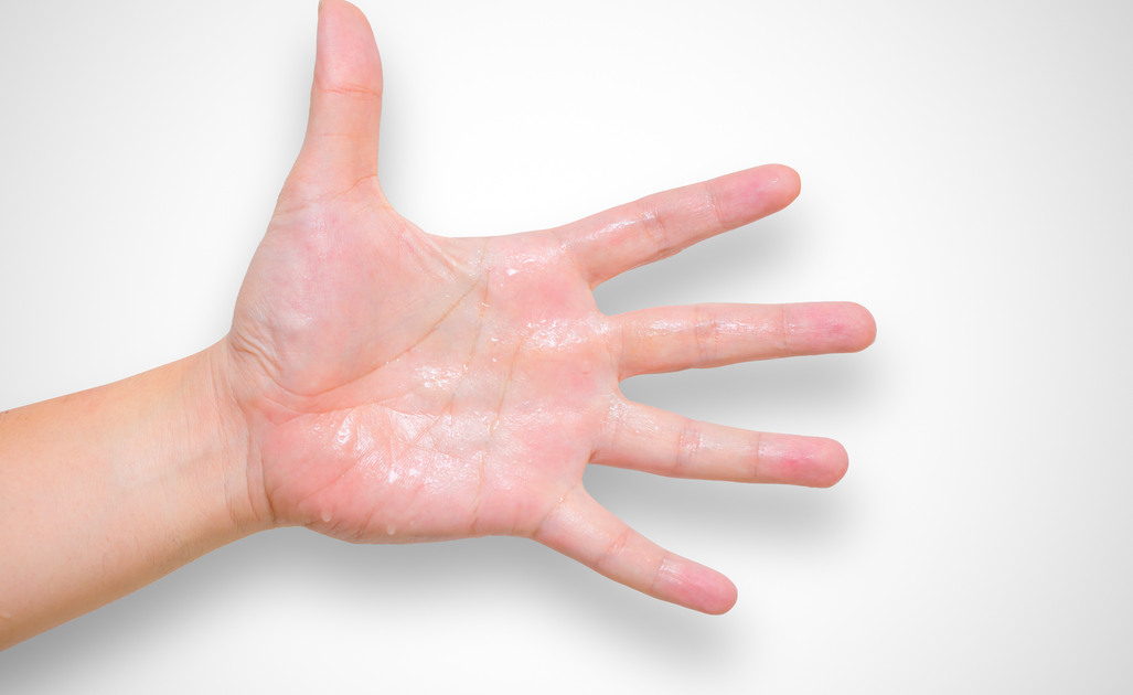 Iperidrosi alle Mani: Cosa Sapere