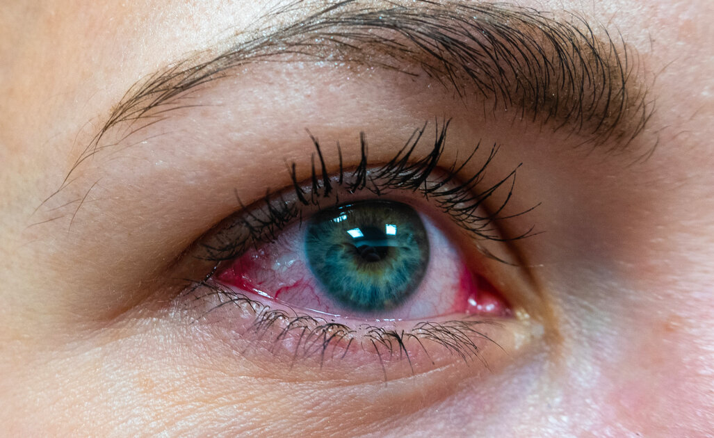 Come Riconoscere la Congiuntivite Allergica