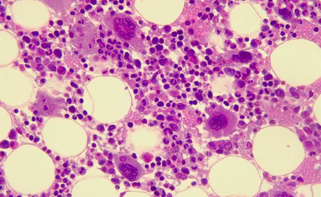 Sindrome Mielodisplastica: Sintomi e Cure