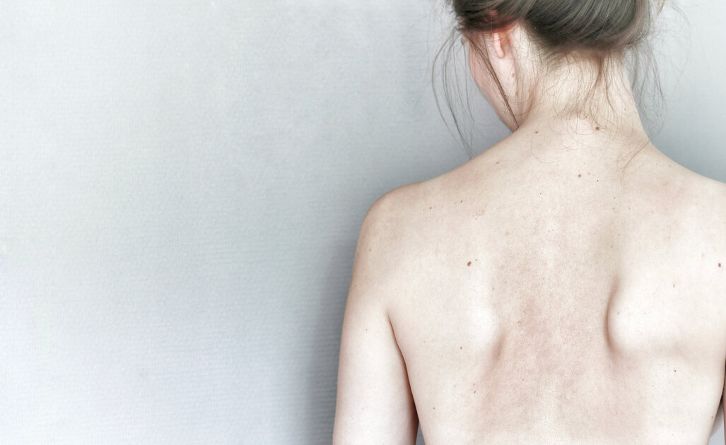 Scapole Alate: Cause e Rimedi