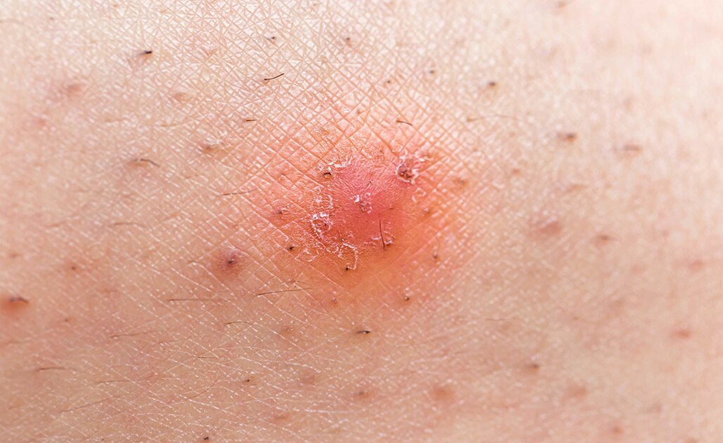 Vediamo Come Eliminare I Peli Incarniti