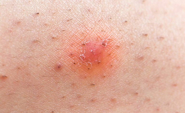 Vediamo Come Eliminare I Peli Incarniti