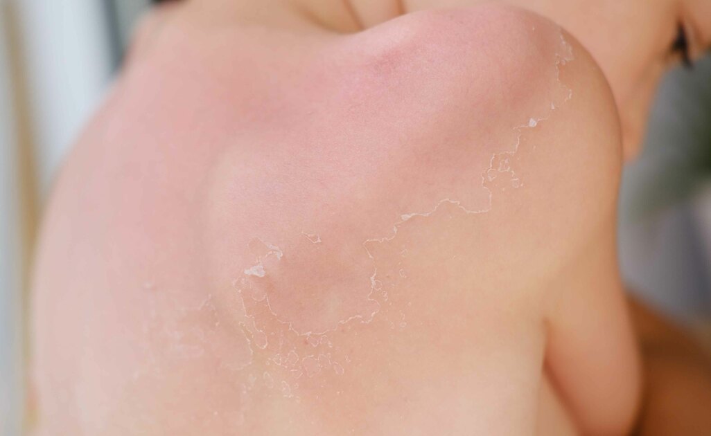 Come Eliminare La Pelle Morta