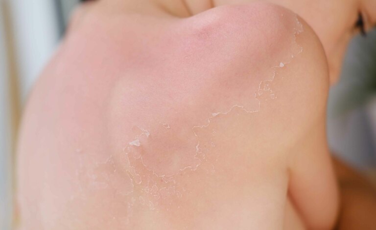 Come Eliminare La Pelle Morta