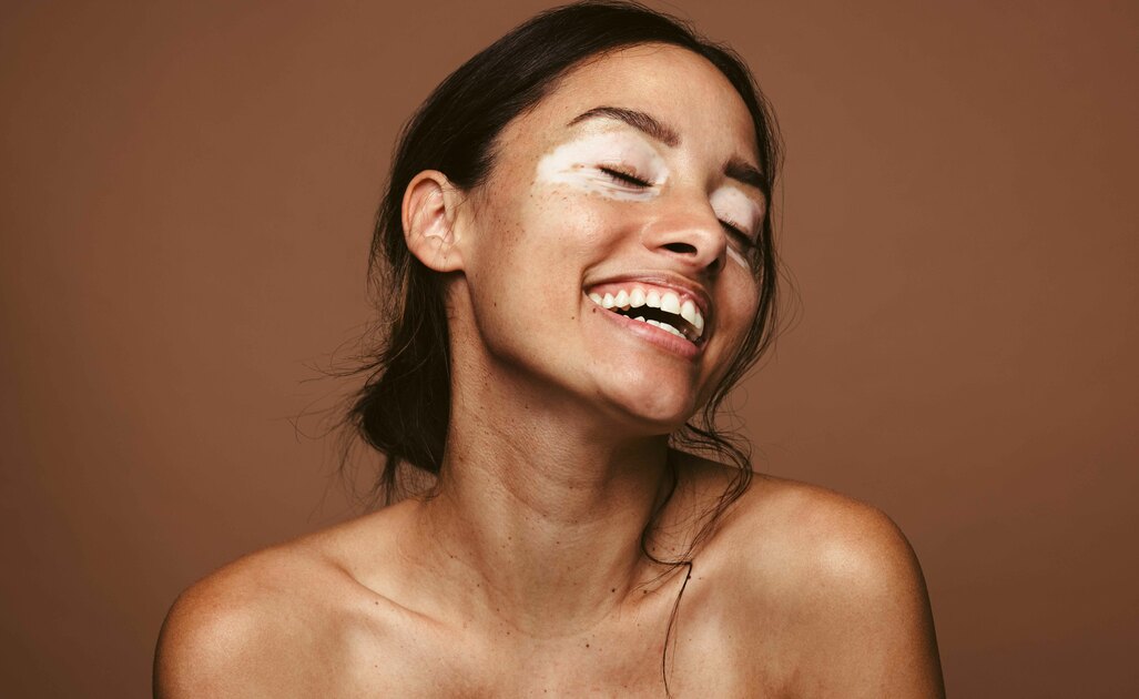 Come Si Cura La Vitiligine