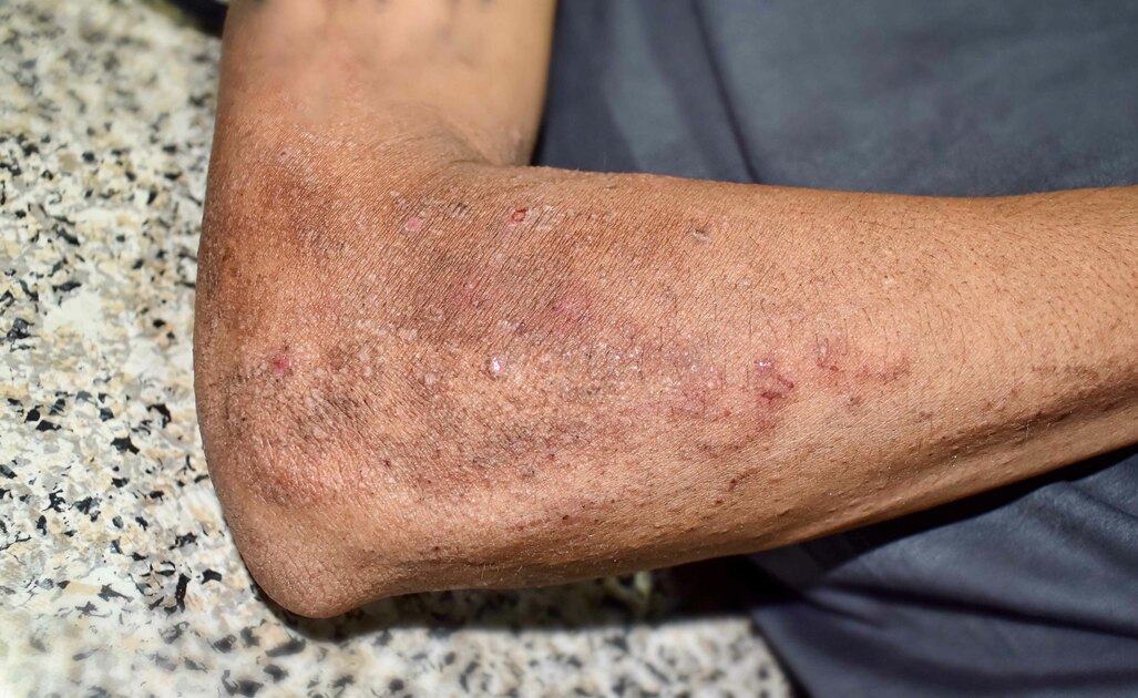 Scopriamo Cosa è La Pellagra